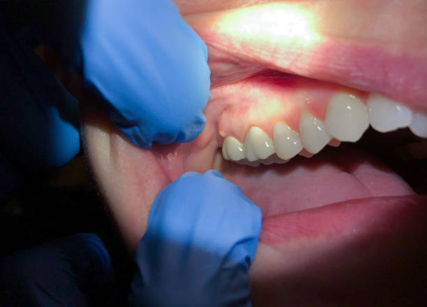 Best Broken or Chipped Tooth Repair in West Slope, OR